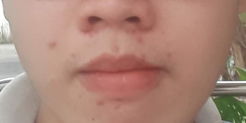 mụn.png mụn.png